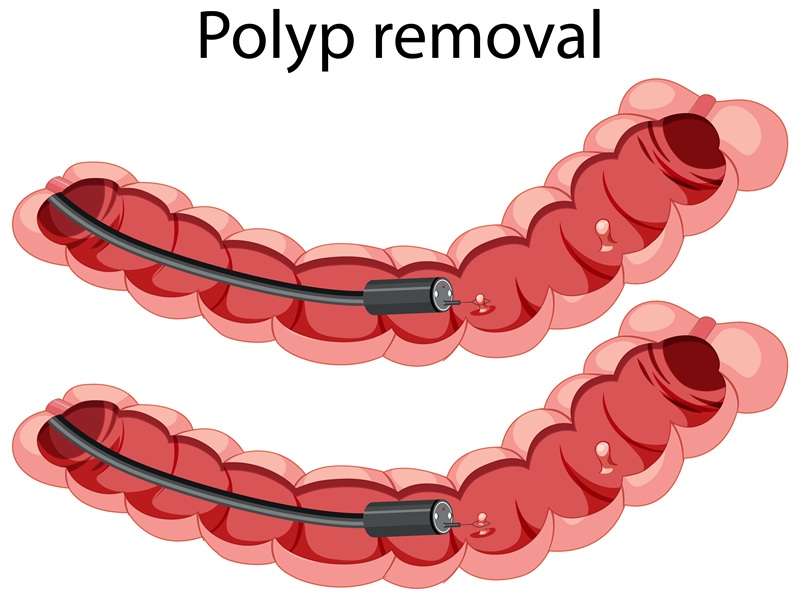 Polyp đại tràng và những lưu ý khi tham gia bảo hiểm nhân thọ