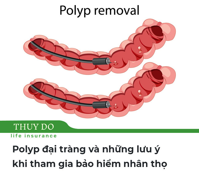 Polyp đại tràng và những lưu ý khi tham gia bảo hiểm nhân thọ